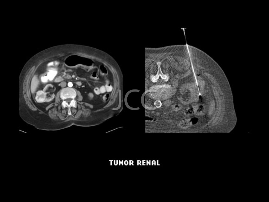 Biópsia Tumor Renal