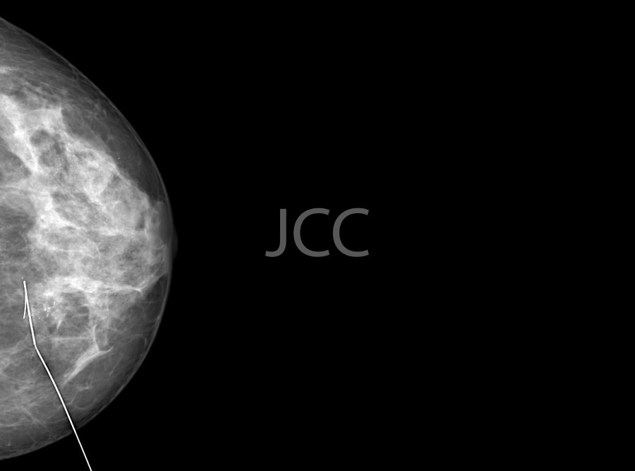 jcc_mamografia_de_aquisicao_digital_colocacao_de_arpao-1.jpg