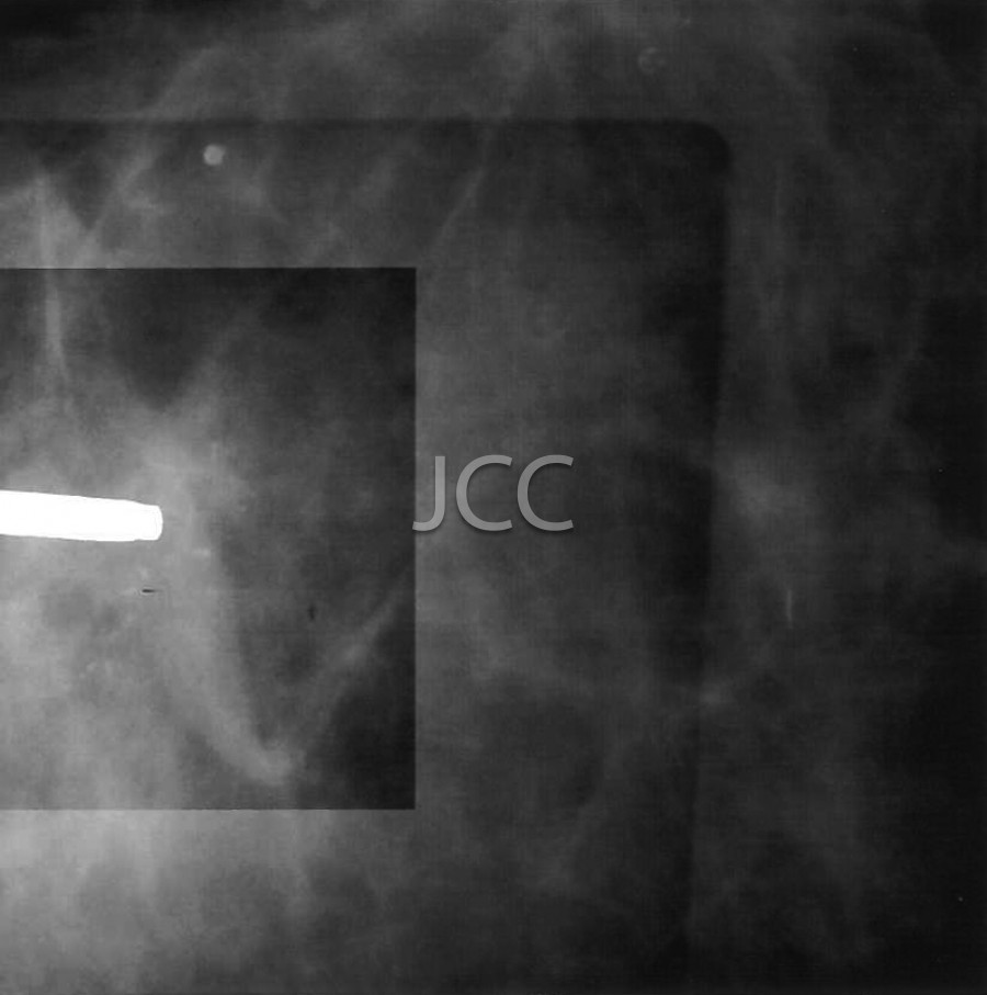jcc_mamografia_de_aquisic_a_o_digital_biopsia_por_estereotaxia.jpg