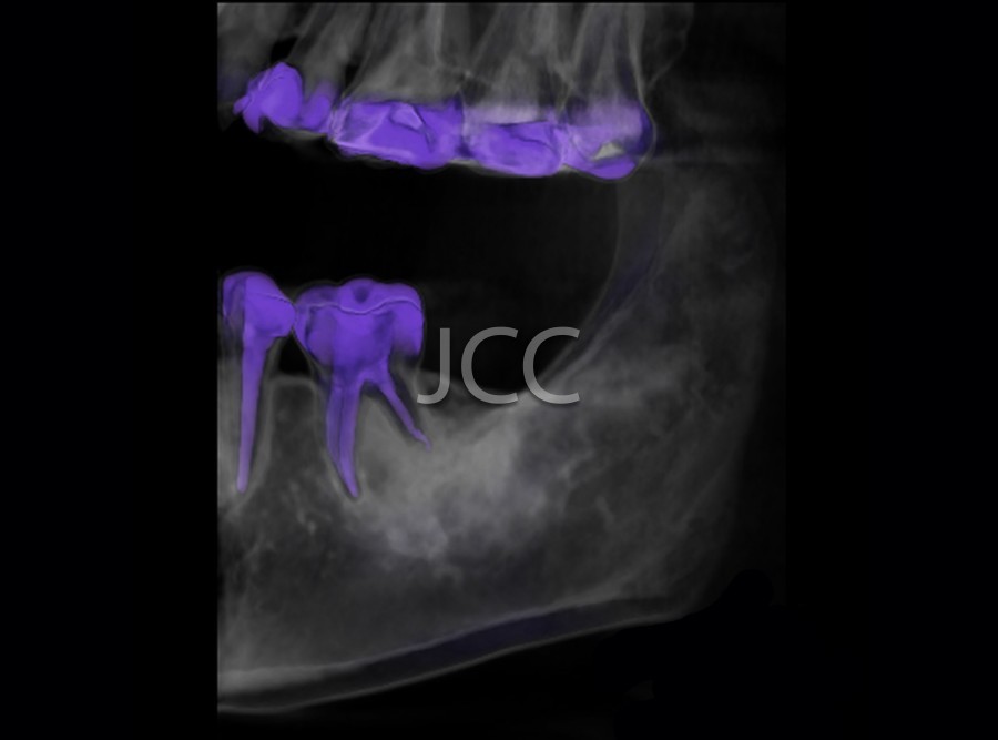 jcc_dental_scan_maxilar_mandibular_1.jpg