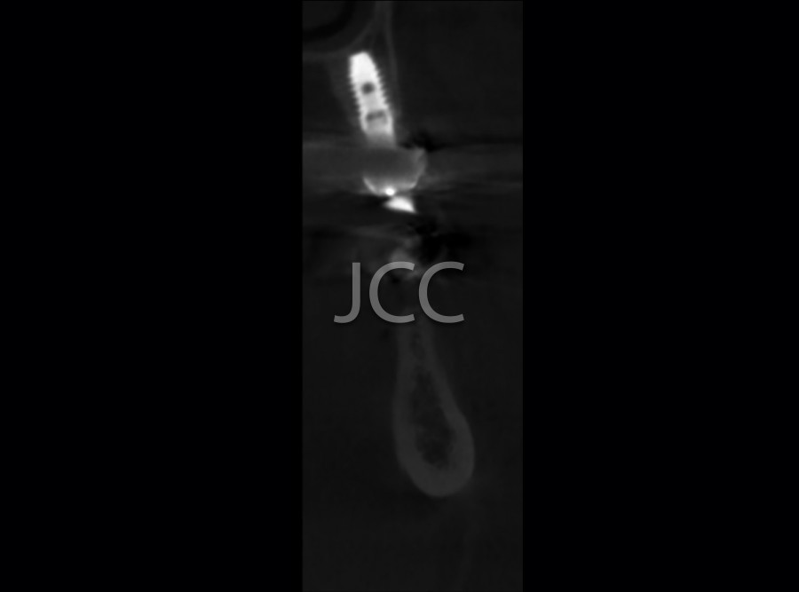 jcc_dental_scan_maxilar_mandibular_3.jpg