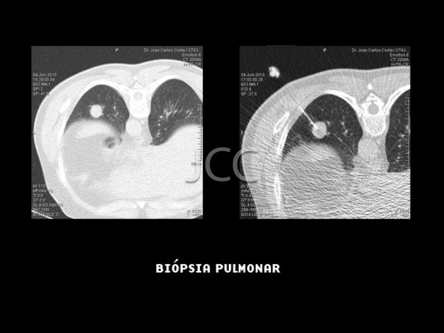 Biópsia Nódulo Pulmonar