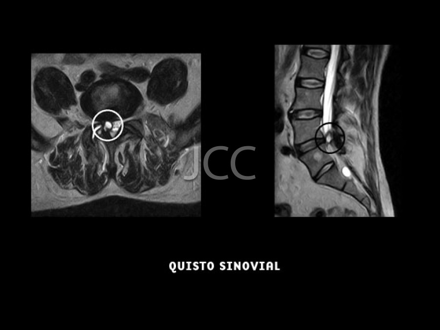 jcc_quisto_sinovial_2.jpg